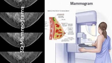 Mammogram